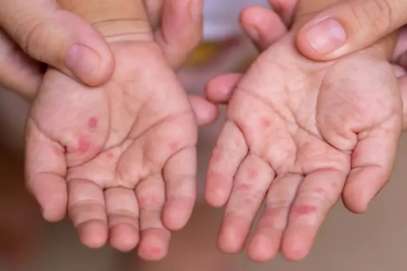 Chiclayo: UGEL dispone medidas preventivas en colegios por virus mano, pie y boca