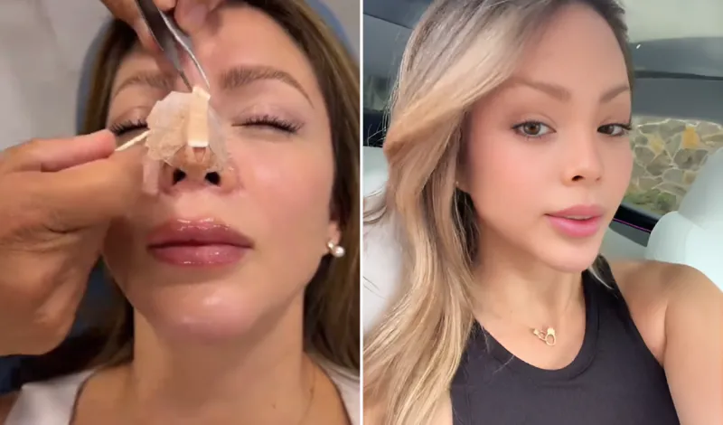 Sheyla Rojas muestra el resultado de su nueva rinoplastia tras retoque estético: "Quería que no me cambie la cara"