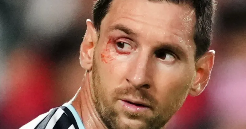 Qué le pasó a Messi en el ojo: el 10 recibió atención en medio de Argentina vs Suiza