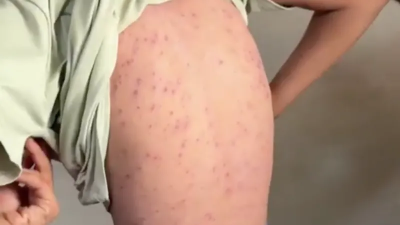 Brote de varicela en Gaza se agrava por las precarias condiciones sanitarias